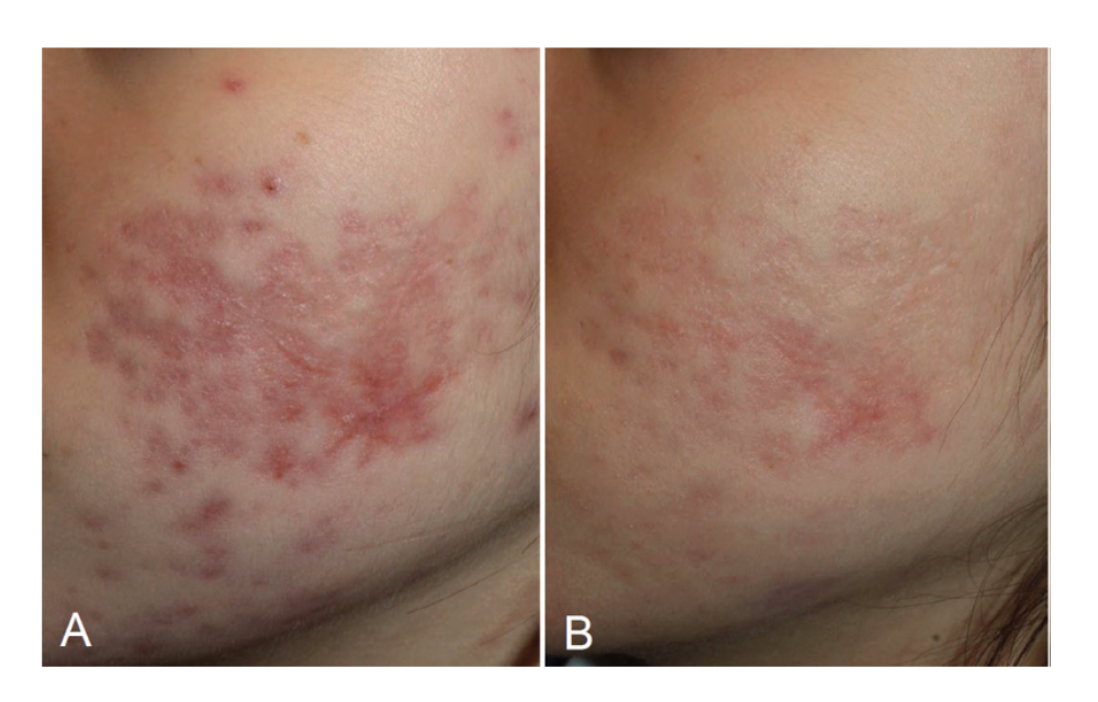 Érythème post-inflammatoire initial (A) et évolution huit semaines après la deuxième séance de radiofréquence (B).