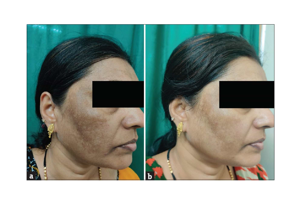 Avant/après traitement par une solution à 50% d'acide glycolique pour une patiente présentant de l'hyperpigmentation.