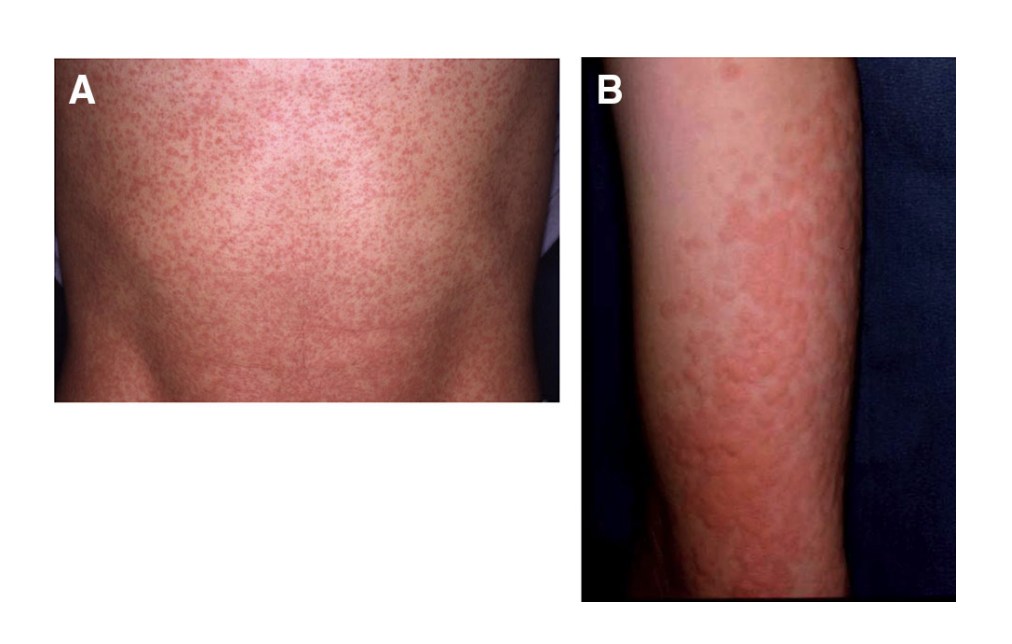 (A) Aspect typique de l’urticaire cholinergique : des papules très prurigineuses, de taille minuscule, avec un érythème environnant. (B) De temps en temps, les papules deviennent plus grandes et fusionnent entre elles.
