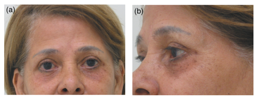 Source : CESTARI T. F. & al. What causes dark circles under the eyes? Journal of Cosmetic Dermatology (2007).
