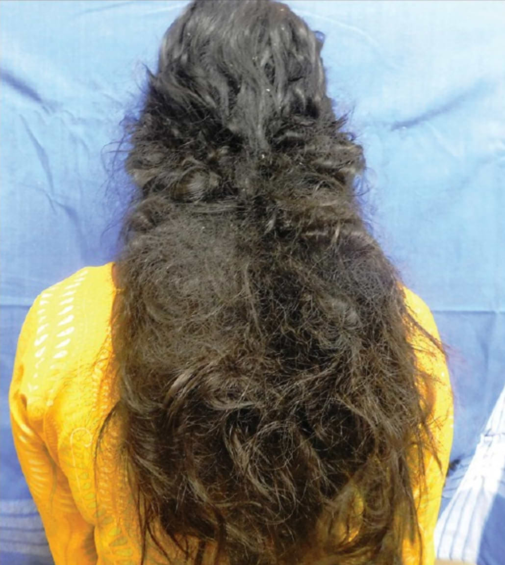 Source : KIRUTHIKA S. & al. Castor oil-the culprit of acute hair felting. International Journal of Trichology (2017).