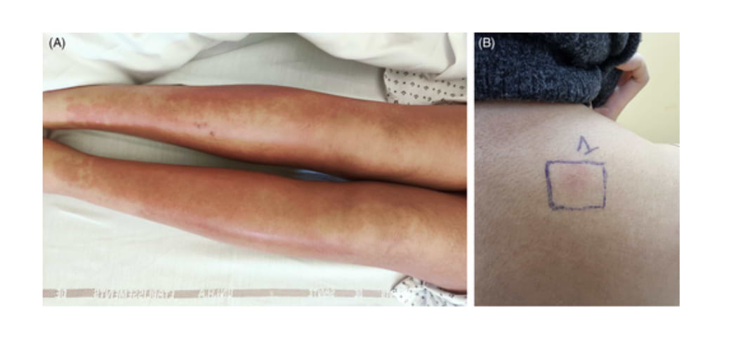 Exanthème avec macules et pustules prurigineux et généralisé (A) ; Test épicutané positif avec 0,001% d’huile de nigelle (B).