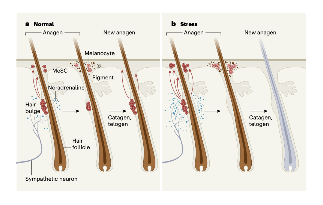 (a) Dans des conditions normales, les cellules souches des mélanocytes (MeSC) migrent (flèches rouges) et se différencient en mélanocytes pendant l’anagène. De nombreuses MeSC restent pour remplacer les mélanocytes dans la prochaine phase anagène. (b) Les stimuli stressants activent le système nerveux sympathique, augmentant la libération de noradrénaline dans les follicules pileux, ce qui provoque une conversion complète des MeSCs en mélanocytes. Le follicule pileux est dépourvu de MeSCs qui se seraient différenciées pour remplacer ces mélanocytes.