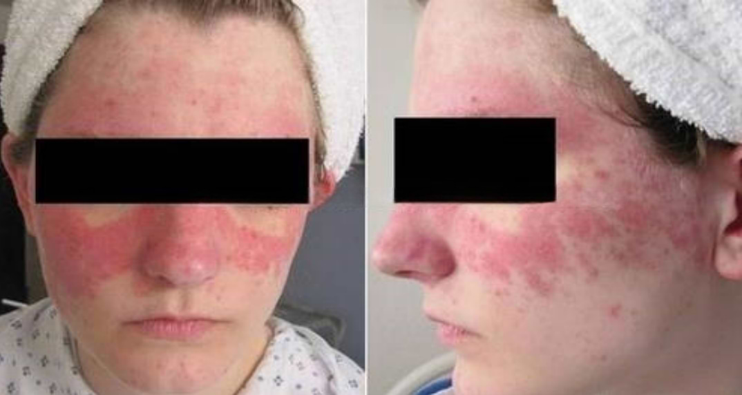Lupus érythémateux systémique.