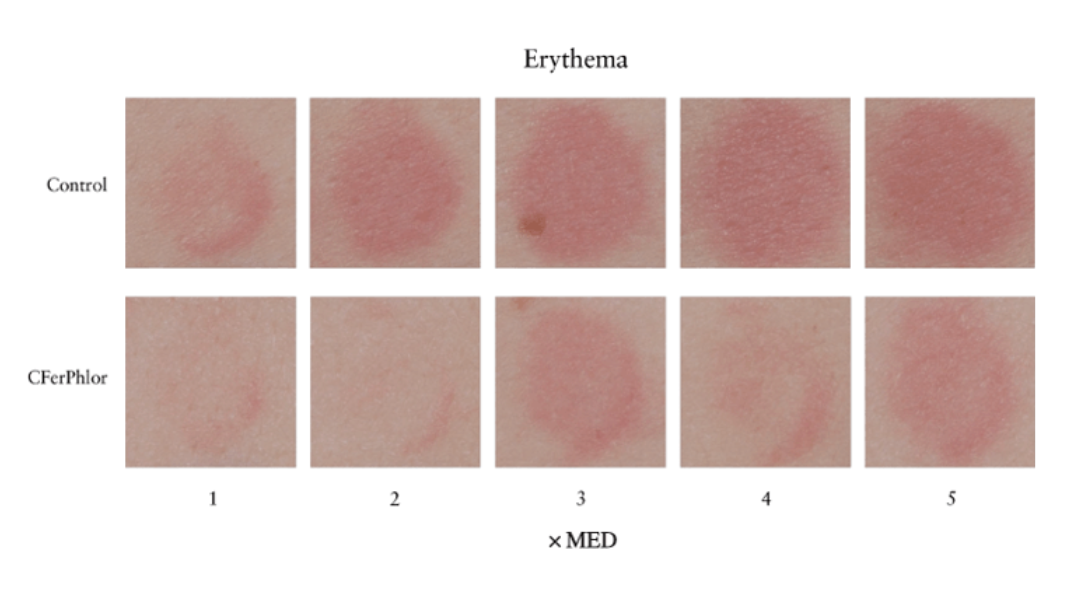 Érythème suite à une irradiation aux UV, suivant ou non l'application d'un soin antioxydant à base de vitamine C et d'acide férulique.