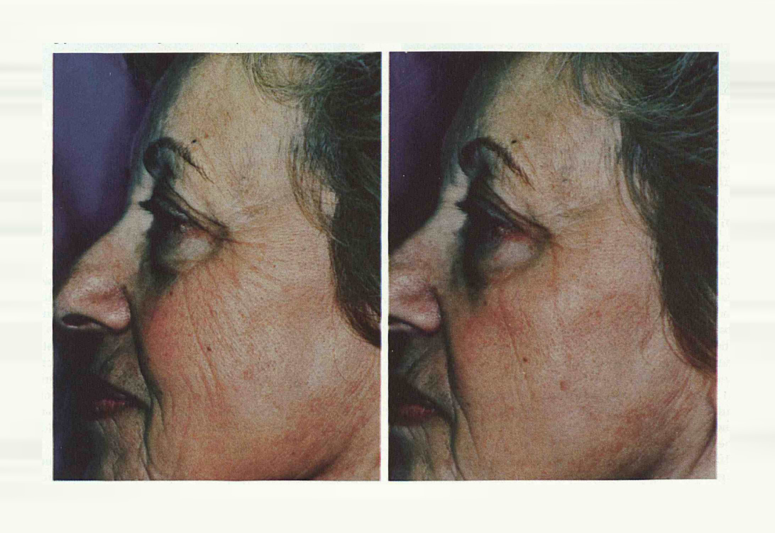 Avant/après un peeling à l'acide glycolique – Réduction visible des rides.