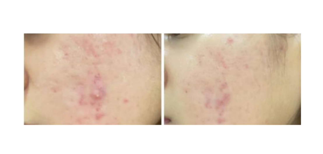 Effets de la combinaison d'AHAs, de BHA et de PHA après trois semaines sur l'acné.