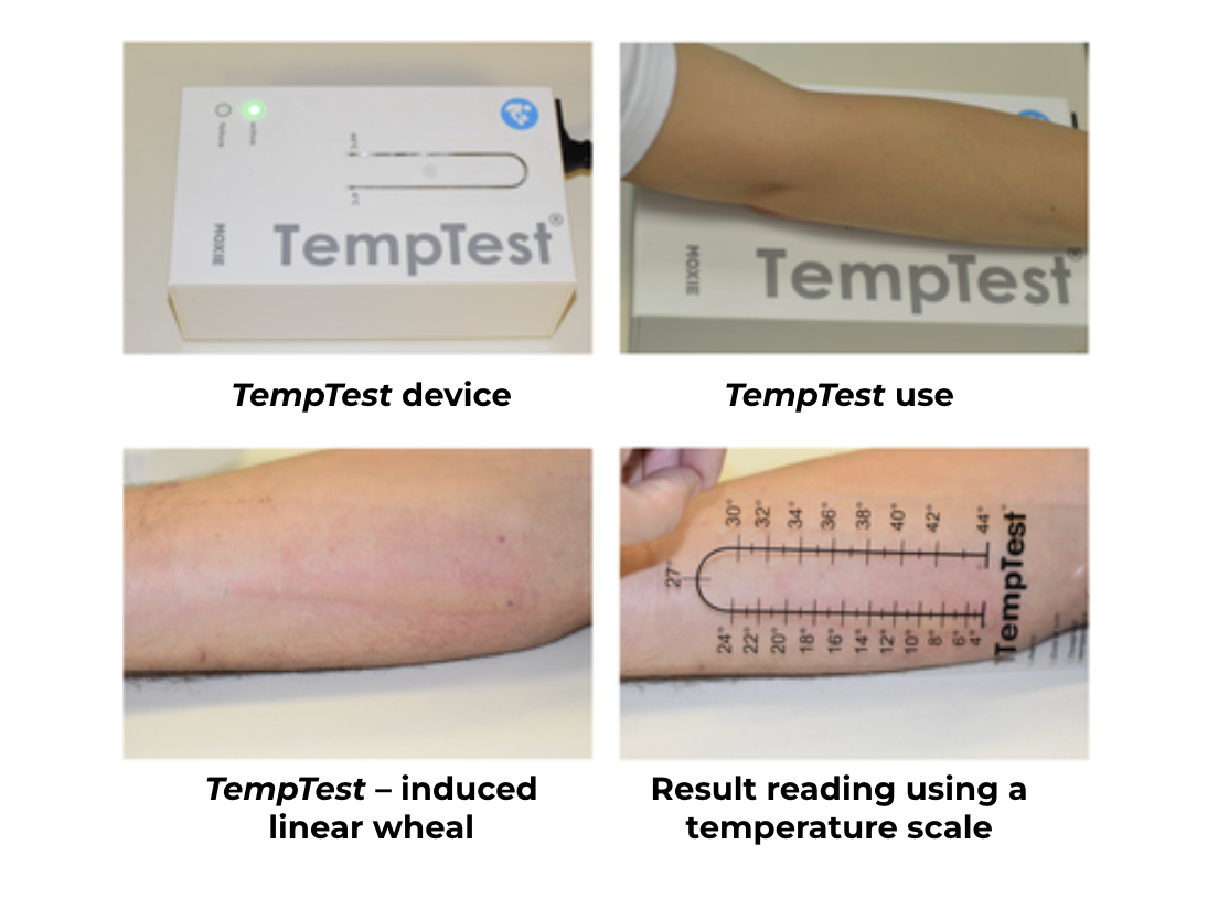 TempTest pour diagnostiquer une allergie au froid.