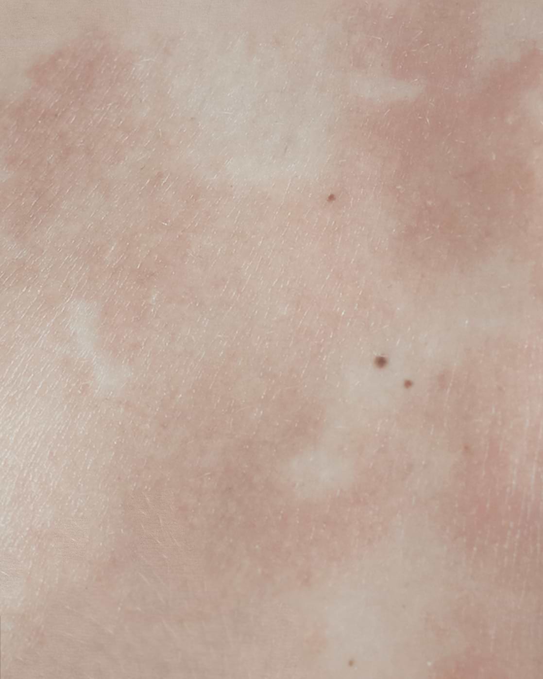Eczéma atopique.