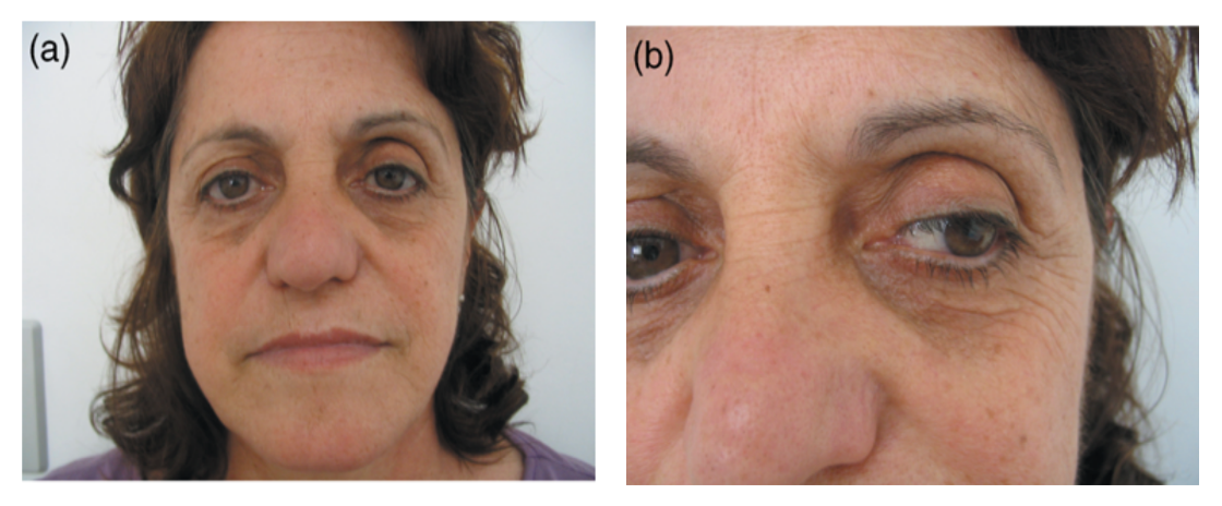 Source : CESTARI T. F. & al. What causes dark circles under the eyes? Journal of Cosmetic Dermatology (2007).