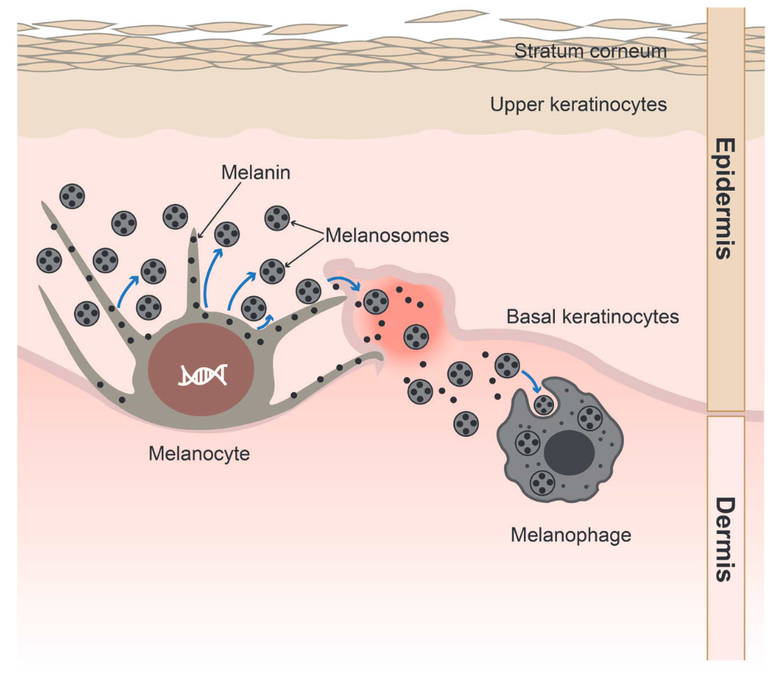 Mécanisme de l'hyperpigmentation post-inflammatoire faisant suite à l'acné.