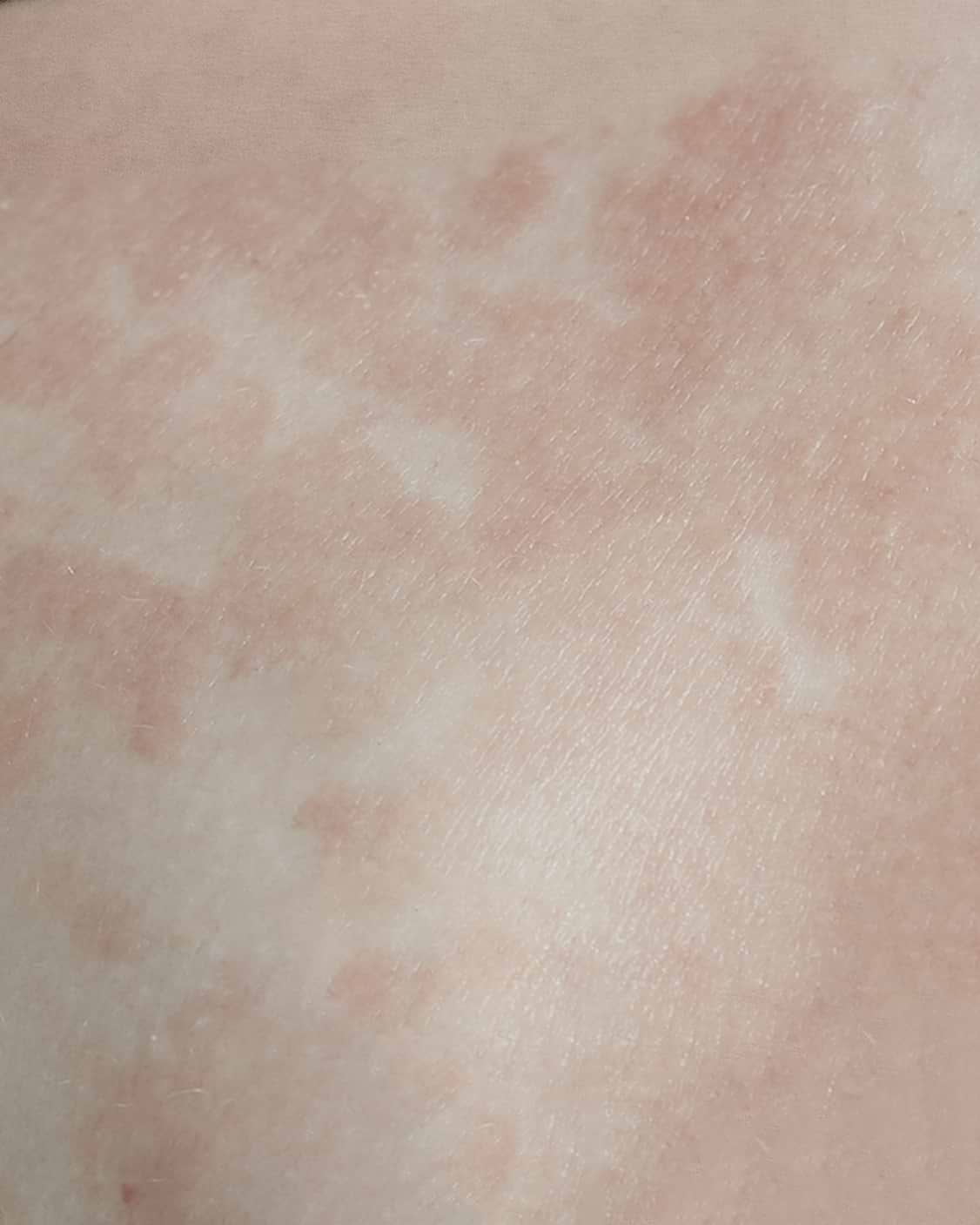 Psoriasis.