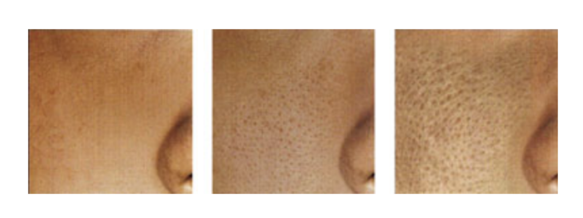 Visualisation des pores de la peau (pores dilatés au centre et à droite).