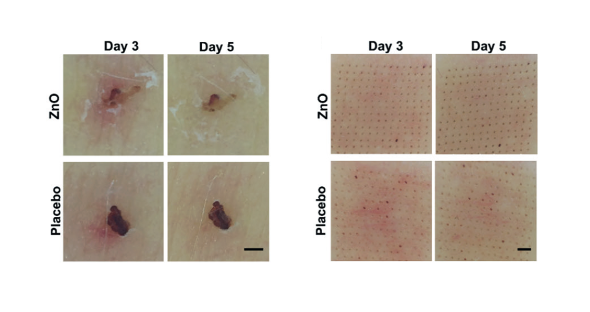 Érythème autour des plaies induites et effet cicatrisant et apaisant d'une émulsion à base d'oxyde de zinc comparée à un placebo.