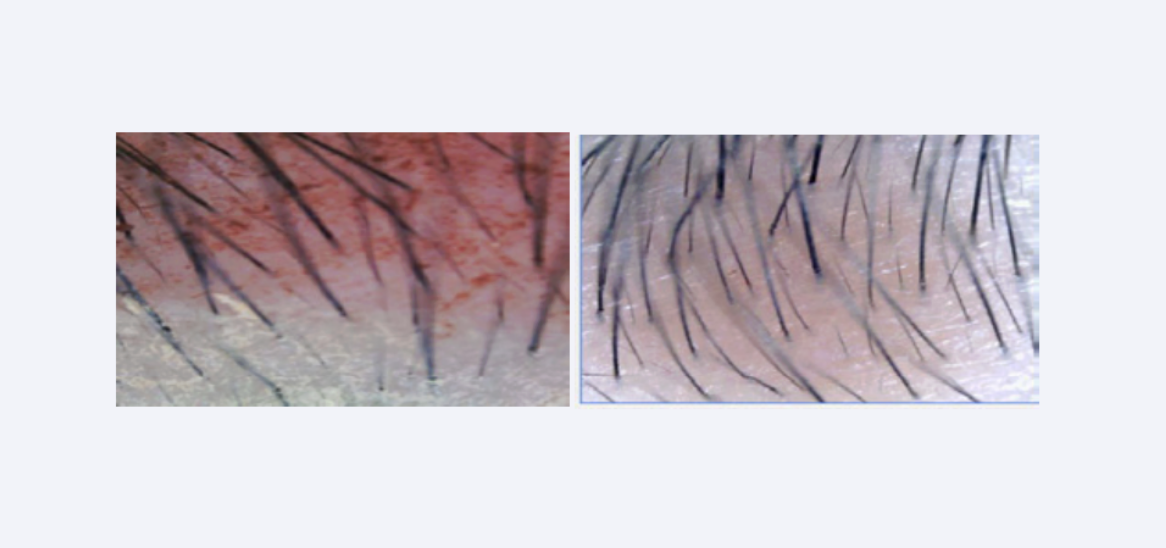 Photographie de la ligne de base du sourcils au début (gauche) et à la fin (droite) de l'étude. Une augmentation significative du nombre de follicules pileux et de la longueur des poils a été notée.