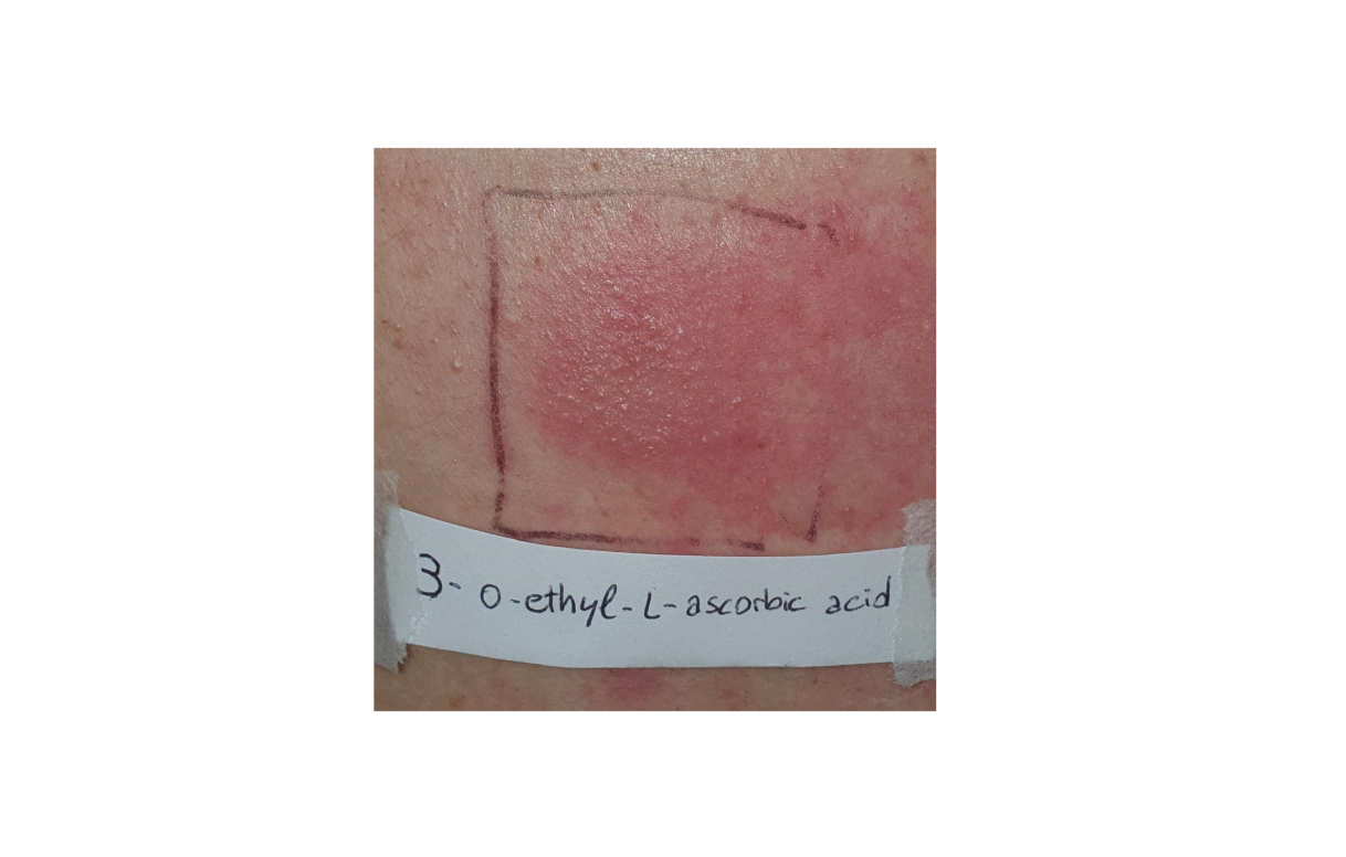 Dermatite de contact suite à l'application de 3-O-Ethyl Ascorbic Acid.