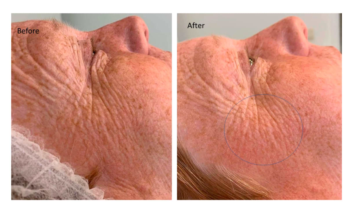 Avant/après une séance de peeling et microneedling sur le visage.