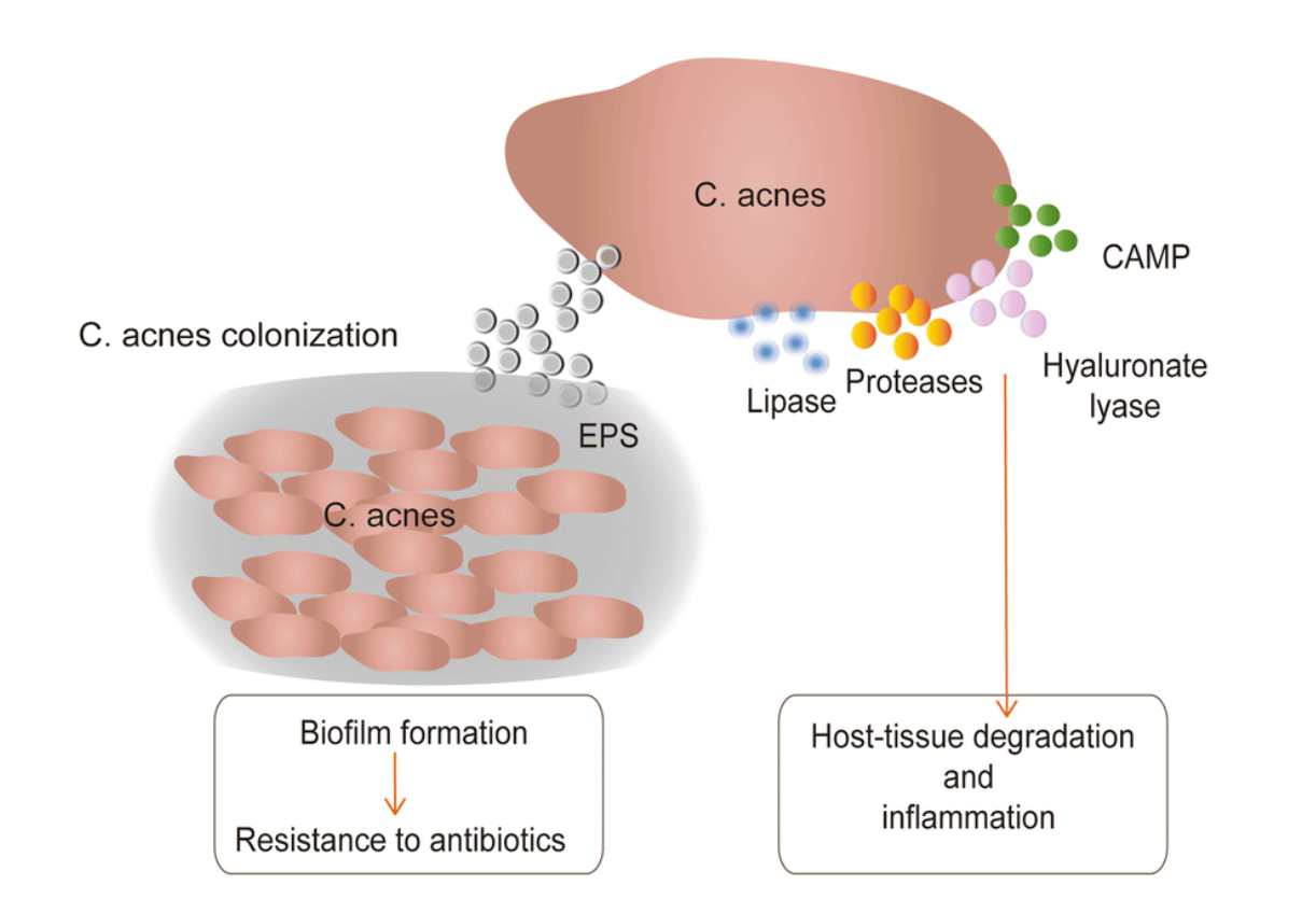 Les principaux processus pathologiques induits par C. acnes dans l’acné.