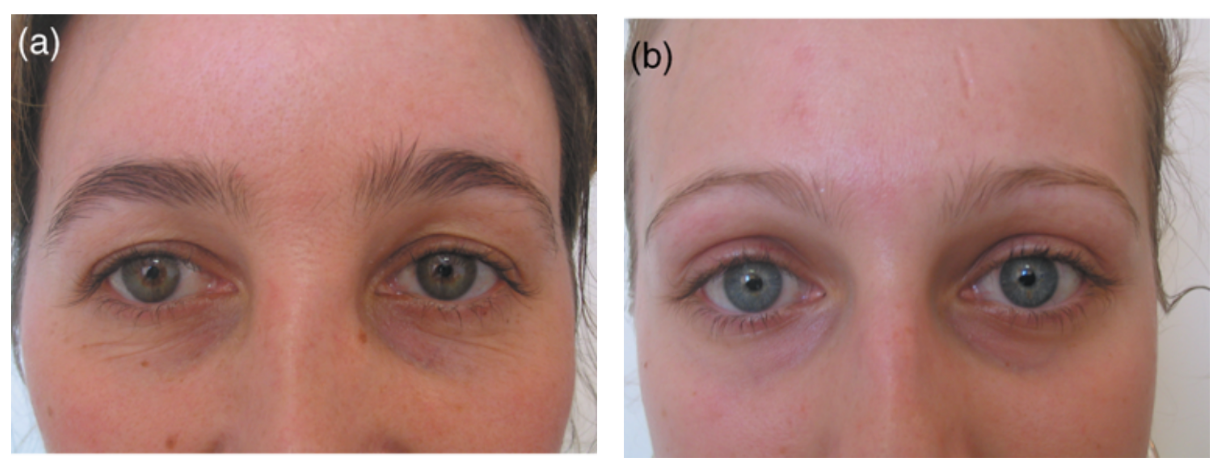 Source : CESTARI T. F. & al. What causes dark circles under the eyes? Journal of Cosmetic Dermatology (2007).
