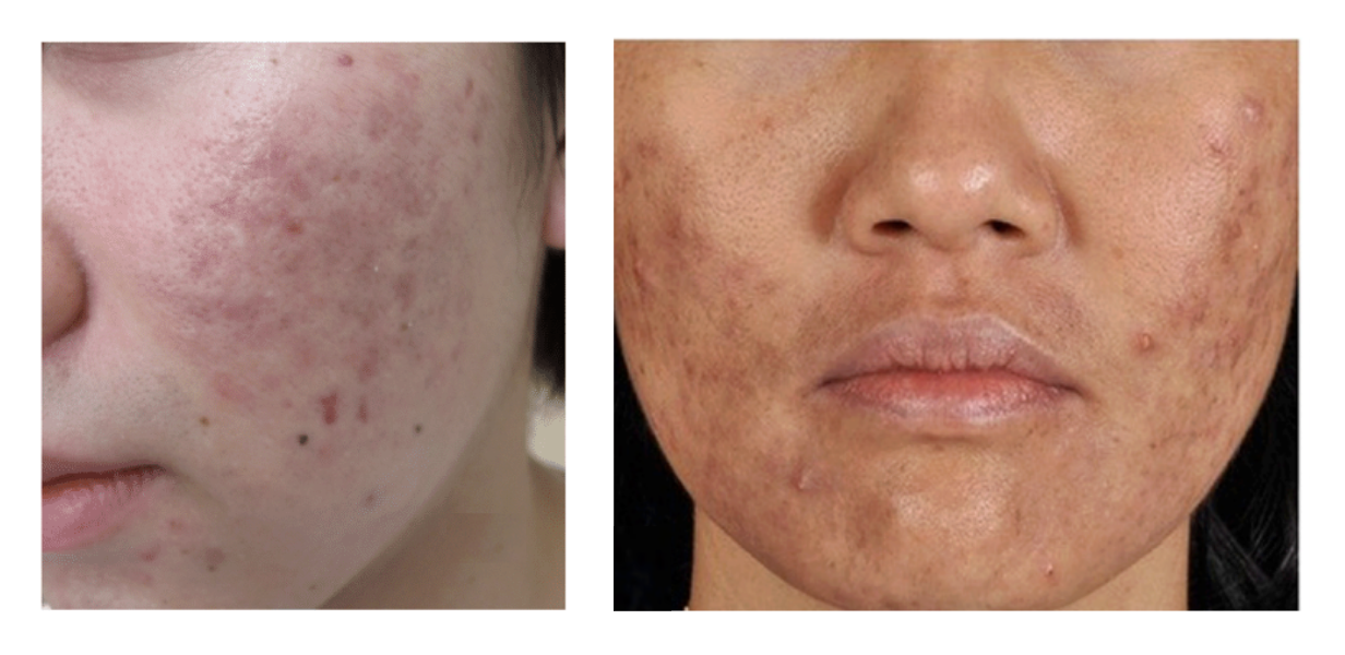 Différences entre l'érythème post-inflammatoire (à gauche) et l'hyperpigmentation post-inflammatoire (à droite).