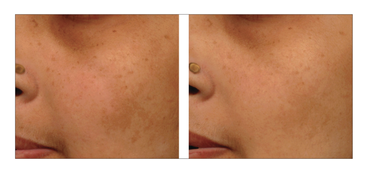 Avant/après application pendant 10 semaines de la lotion contenant la vitamine E et le panthénol.