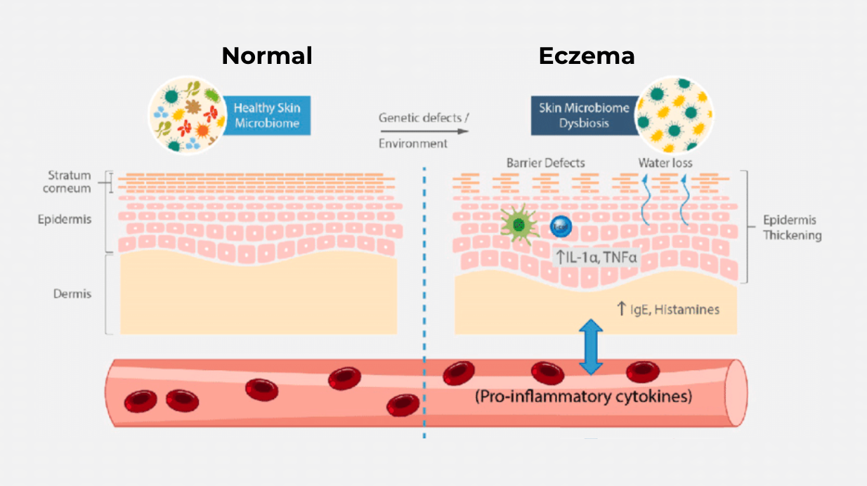 La contribution du microbiote de la peau à la fragilisation de la barrière cutanée dans l'eczéma.
