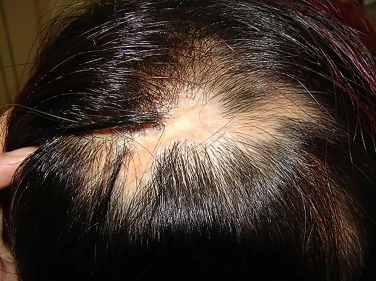 Alopécie cicatricielle lupus.