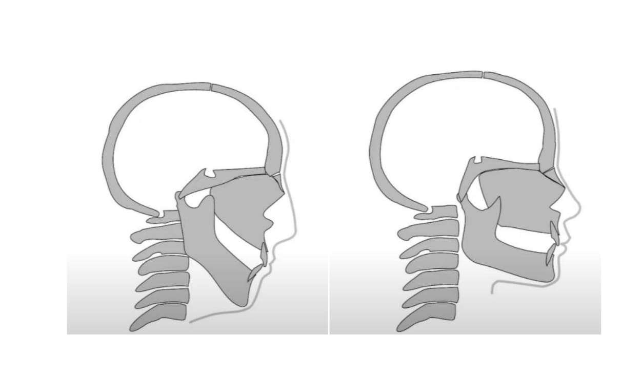 Les potentiels effets du mewing sur le visage.