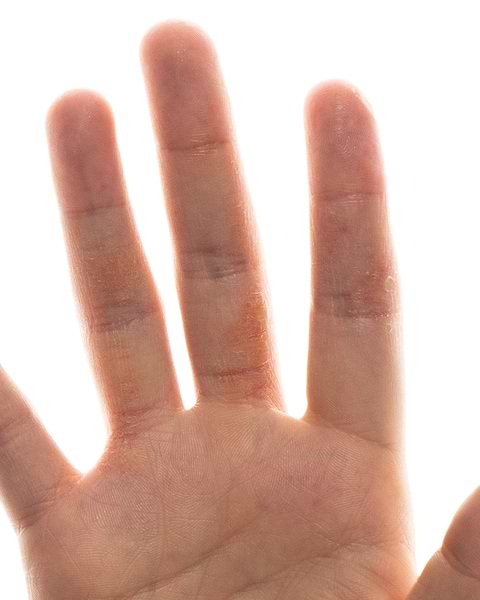 Solutions psoriasis mains et pieds.