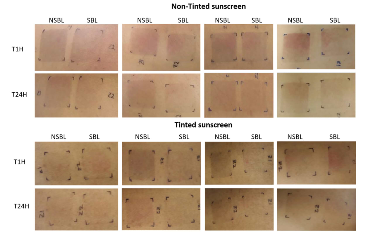 Évaluation de l'effet photoprotecteur du TriAsorB ; NSBL (sans protection solaire), SBL (protection solaire).