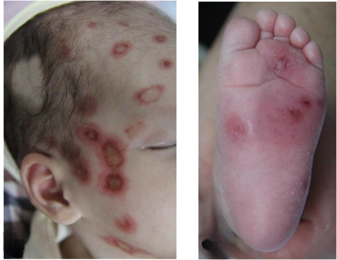 Lupus néonatal.