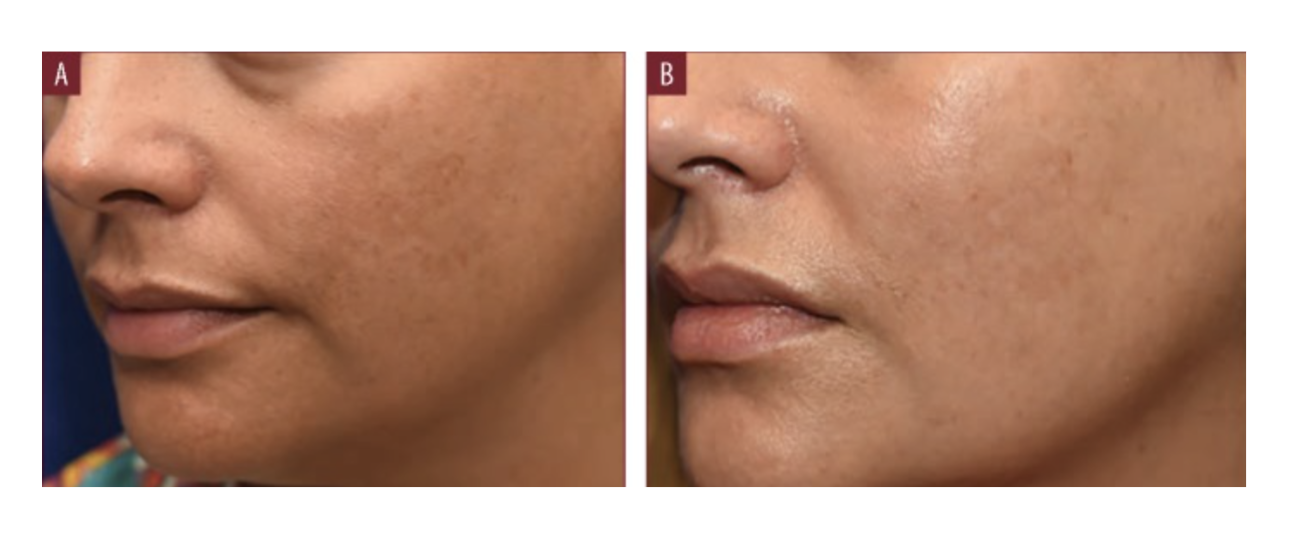 Avant/après traitement d'une personne avec de l'hyperpigmentation sur les joues.