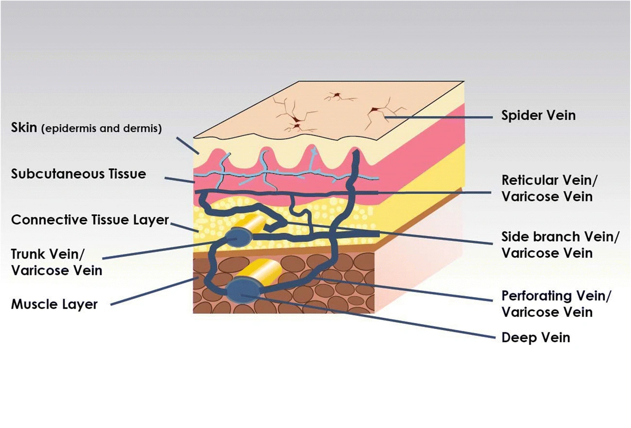 Location of different types of varicose veins.
