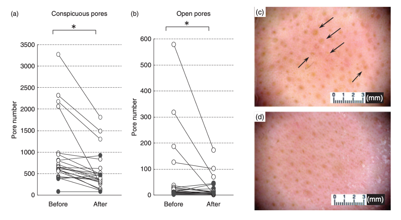 Changements dans le nombre de pores visibles (a) et ouverts (b) avant et après les peelings à l’acide glycolique ; Images de la peau d'une volontaire avant (c) et après (d) les peelings (les flèches montrent des bouchons kératosiques dans les pores).