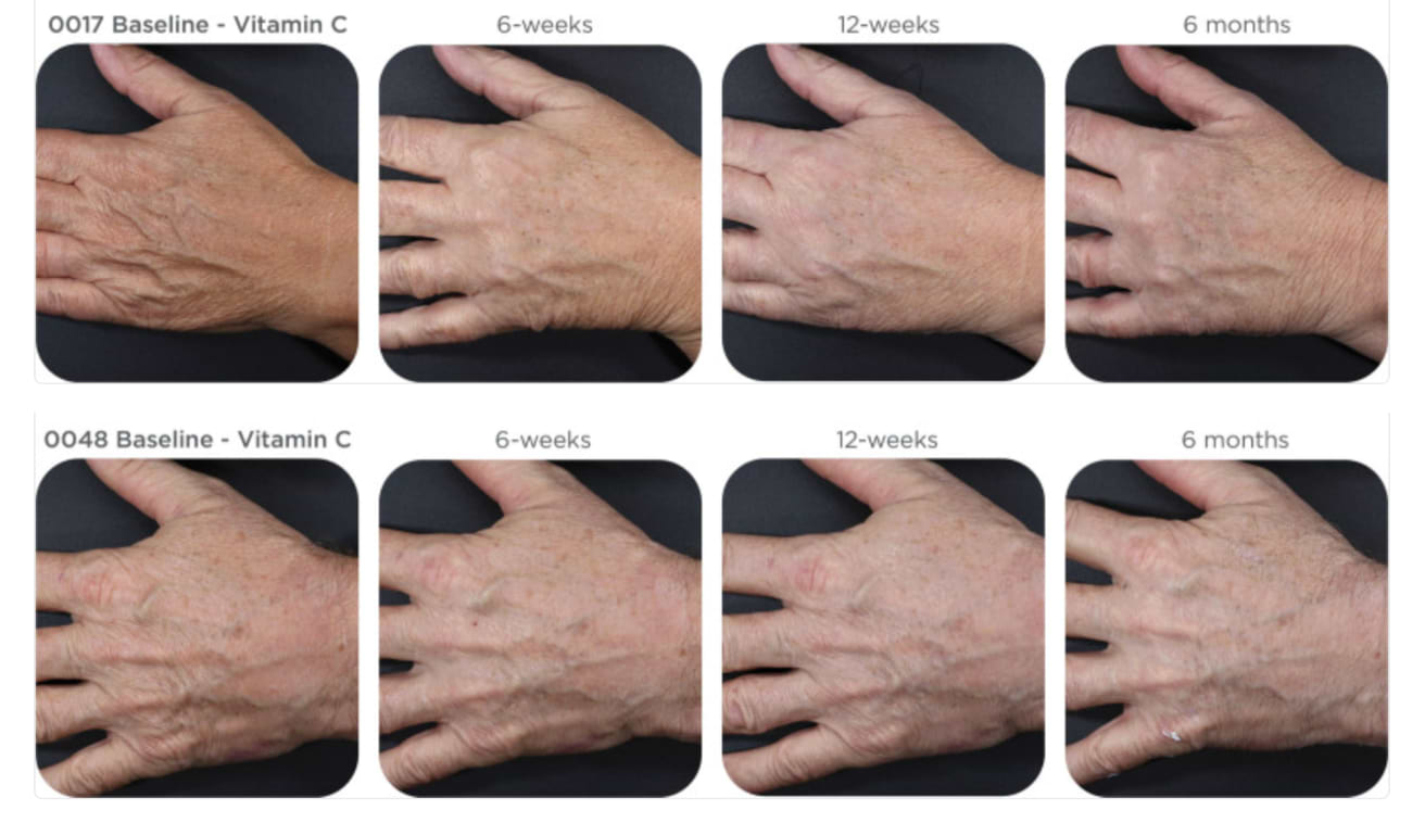 Photographies illustrant les effets de l'application d'un sérum à 15% de vitamine C sur les signes de vieillissement des mains.