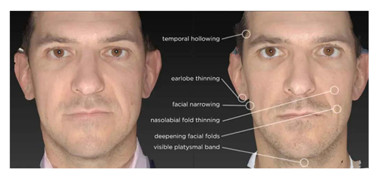 Avant (gauche)/après (droite) la prise d'Ozempic, avec des manifestations de l'"Ozempic face".