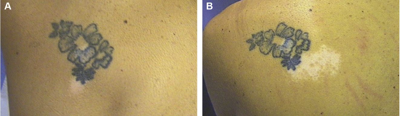 Cas de vitiligo suite à un tatouage (A : lésion initiale en 2007 ; B : extension progressive en 2010).