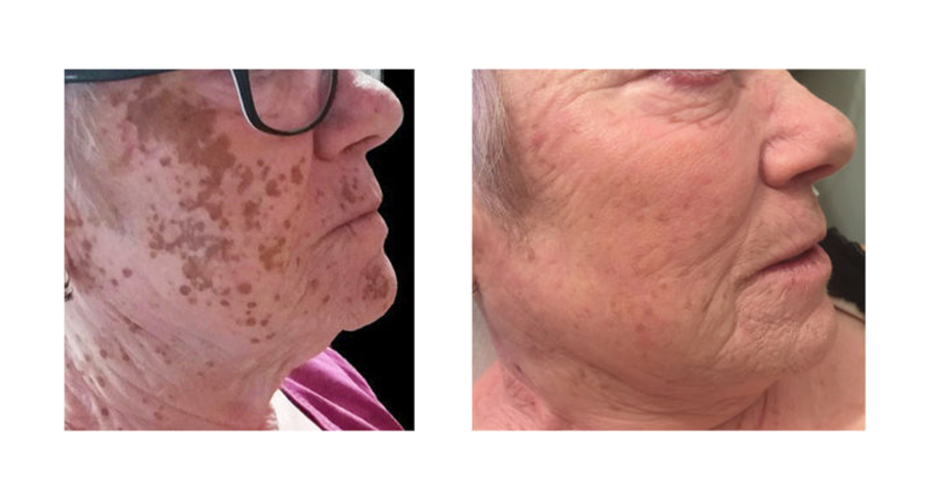 Avant/après quatre séances de peeling au phénol 88%.