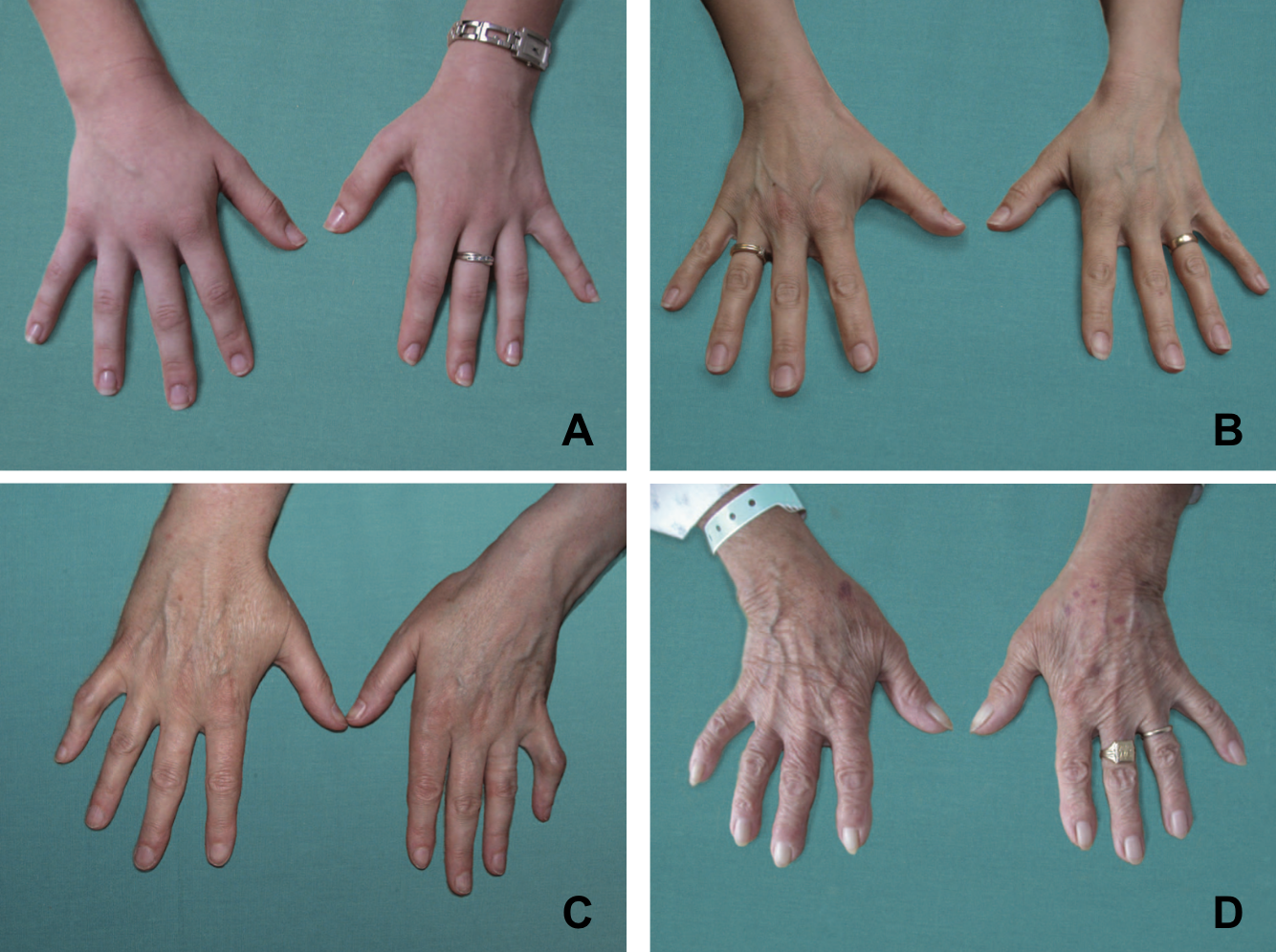 Évolution peau des mains âge.