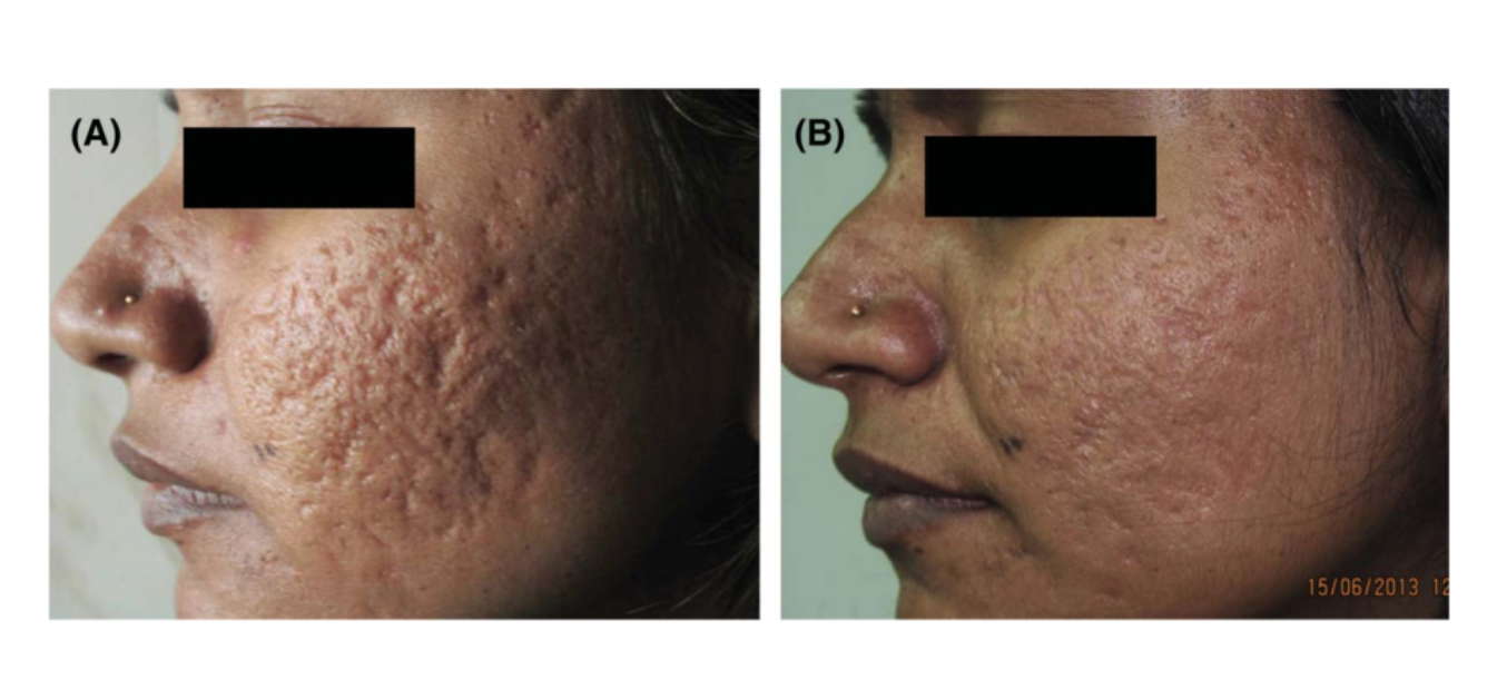 Peeling dermatologique au TCA (70%) : avant/après à 3 mois.