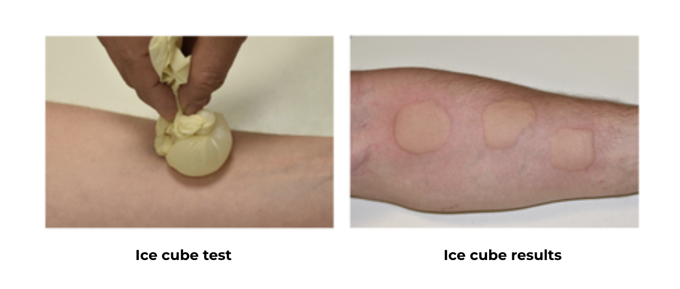 Test au glaçon pour diagnostiquer une allergie au froid.