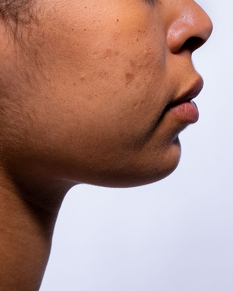 Différents types d'hyperpigmentation.