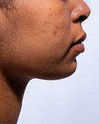 Fiches d'identité : Hyperpigmentation (taches brunes).