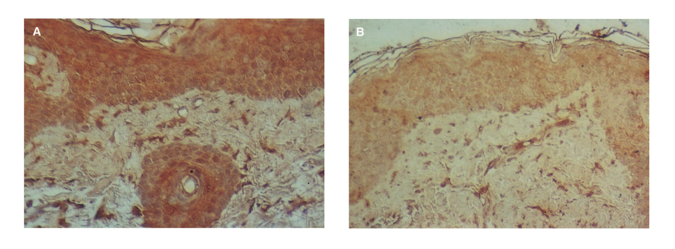 Coloration immunohistologique de l’ARNm pour le collagène de type I dans une biopsie du côté traité à la vitamine C (A) et au véhicule (B). Une coloration moins visible est observée du côté placebo.