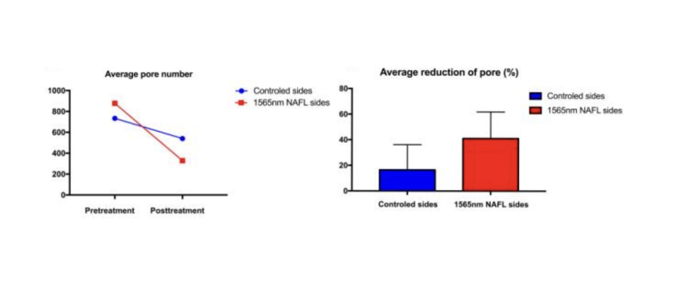 Comparaison du nombre moyen de pores avant et après le traitement laser et quantification de la réduction du nombre de pores.
