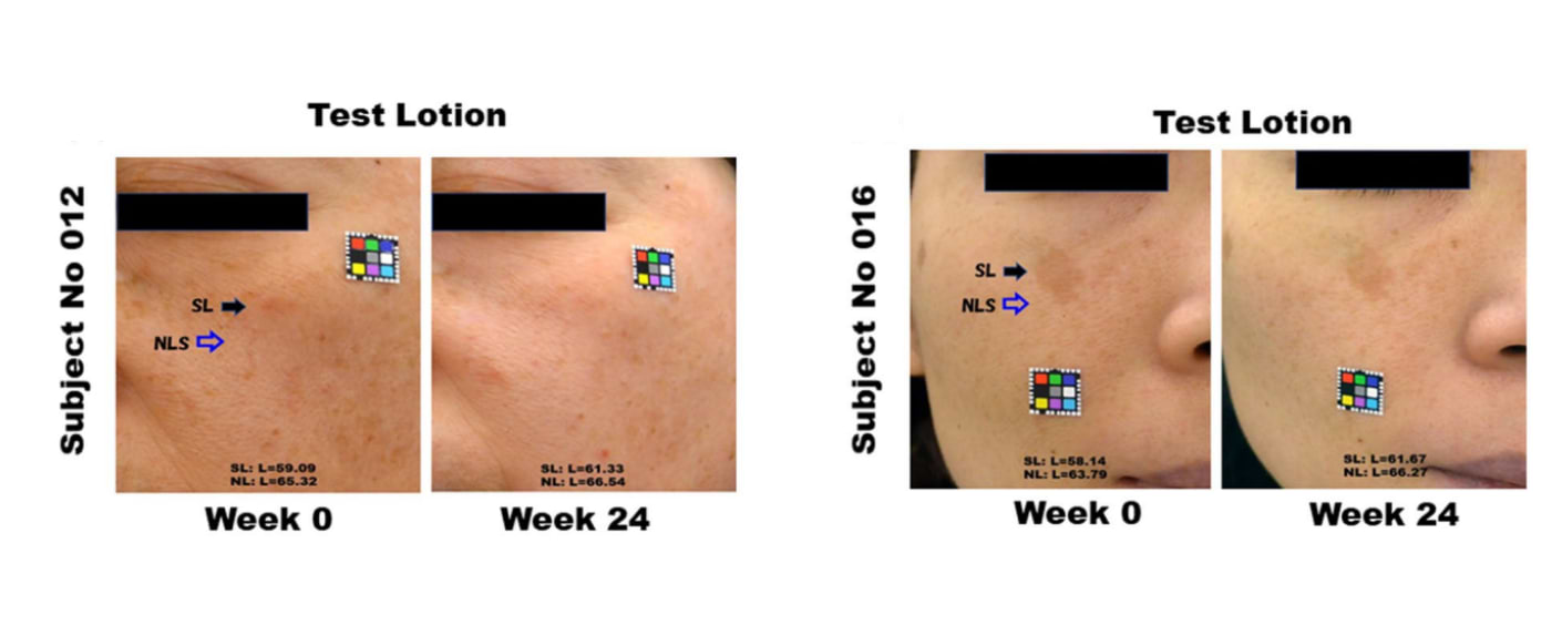 Photographies de 2 volontaires avant et après 24 semaines d'utilisation d'un dérivé de vitamine C.