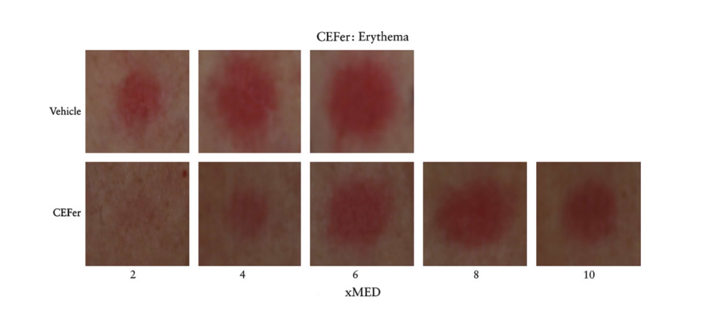 Effet photoprotecteur de l'association acide férulique, vitamine C et vitamine E contre l’érythème induit par les UV.
