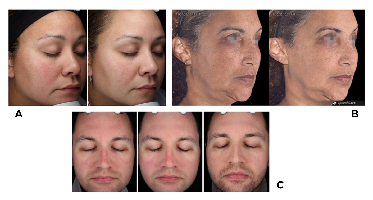 Photographies de trois participants (A : femme de 38 ans, semaines 0 et 8 ; B : femme de 56 ans, semaines 0 et 8 ; homme de 34 ans, semaines 0, 2 et 8).