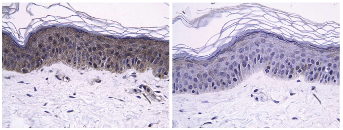 Coloration histologique pour la métalloprotéinase matricielle 9 avant (à gauche) et après 12 semaines d'application d'une crème à 8% d'acide lactobionique. La diminution de la densité de la couleur brune démontre une réduction de la coloration de la métalloprotéinase matricielle 9.
