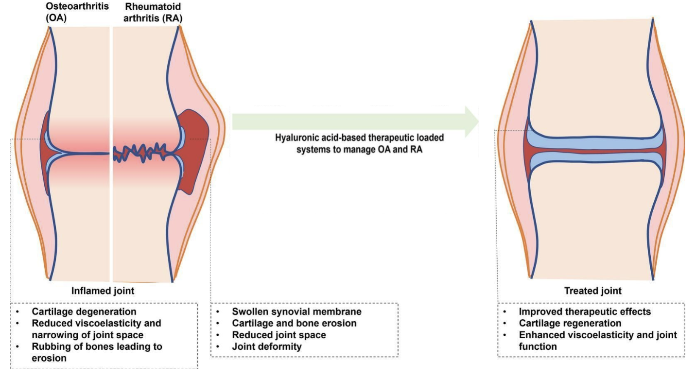 Effets de l'acide hyaluronique sur les articulations touchées par une inflammation.